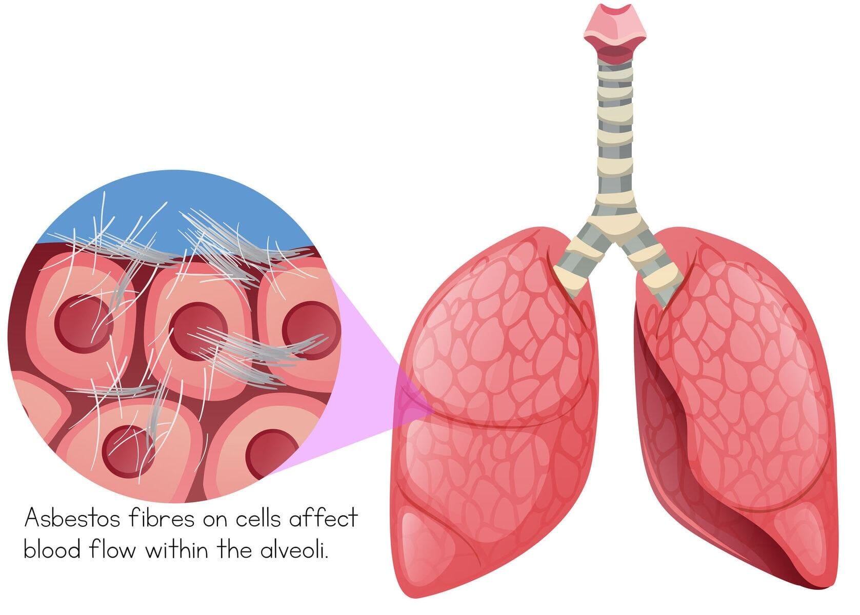 asbestosis onset from fibres Asbestos Fibres on Cells Within Lungs - asbestosis