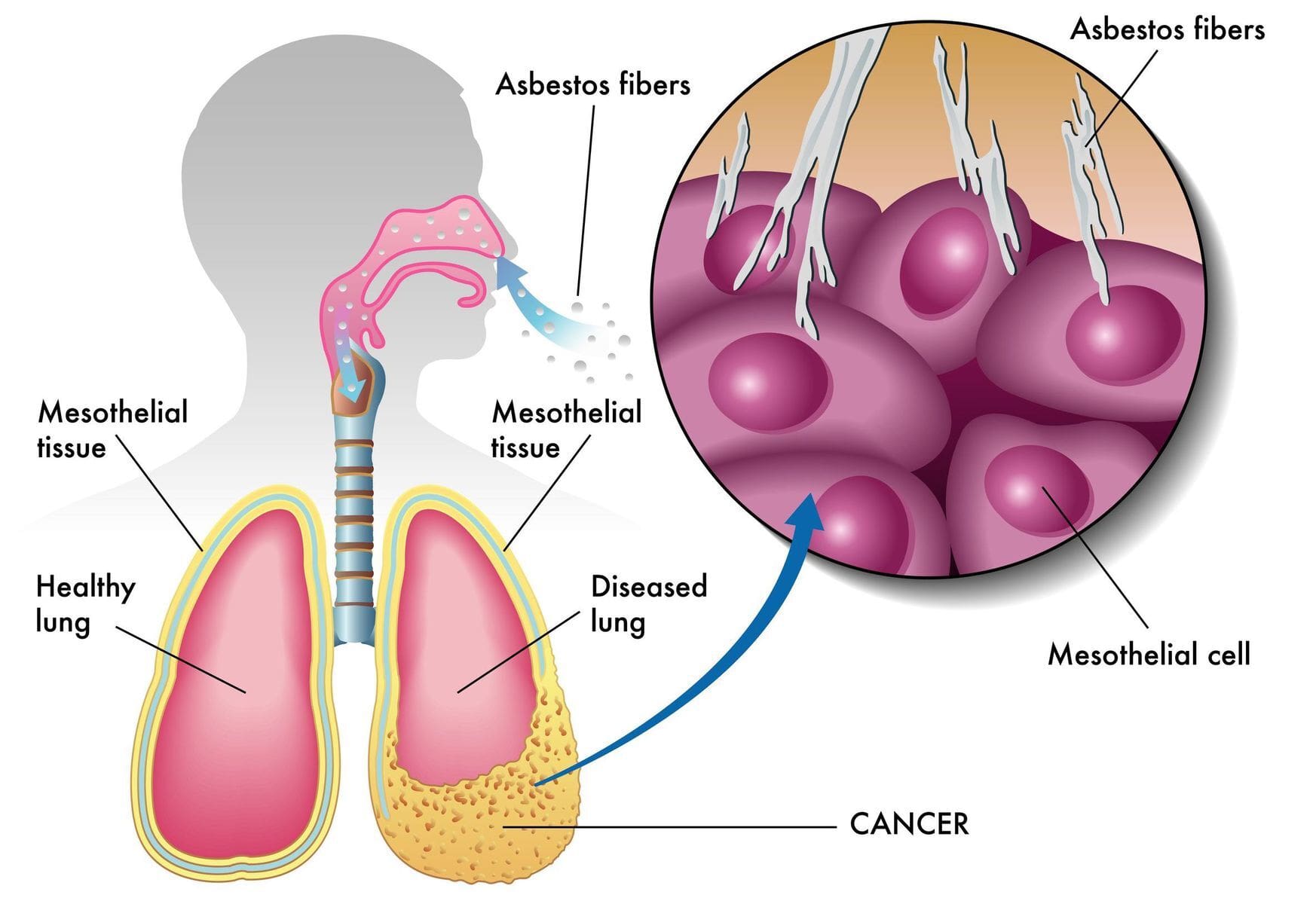 mesothelioma caused by asbestos mesothelioma caused by asbestosis
