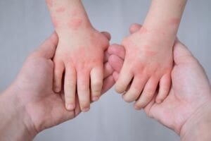 What is a Food Allergy