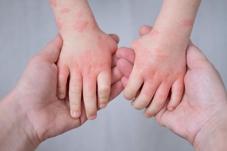 What is a Food Allergy