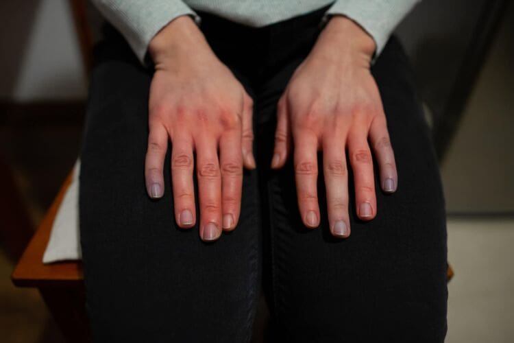 What is Raynaud's