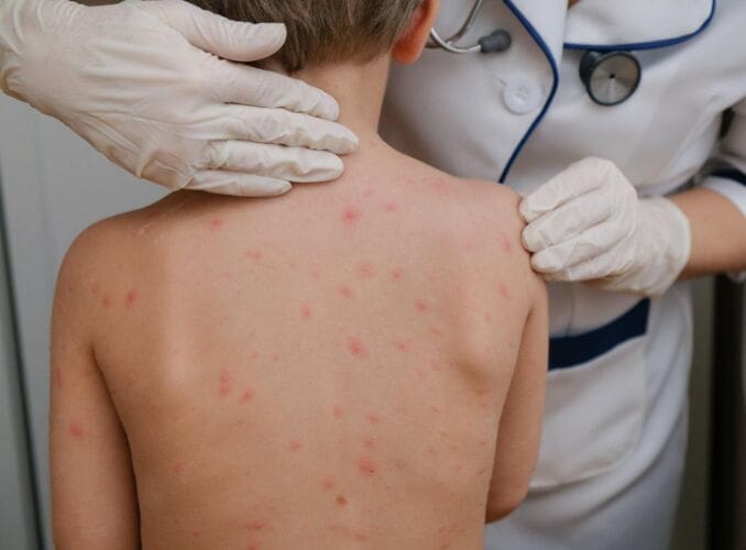 What is Chickenpox?