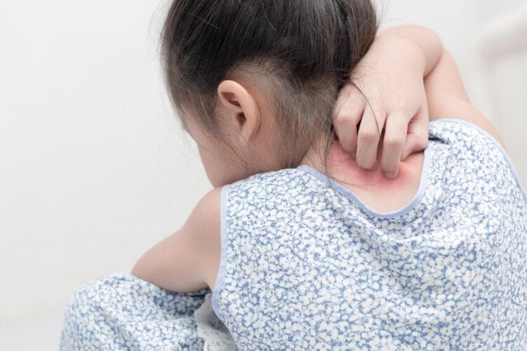 What is eczema
