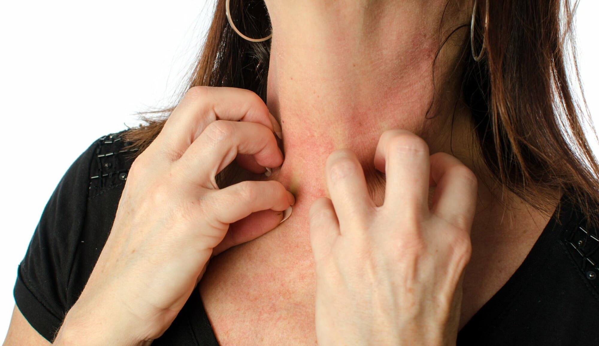 Woman suffering from eczema Woman suffering from eczema