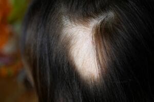 What is Alopecia?