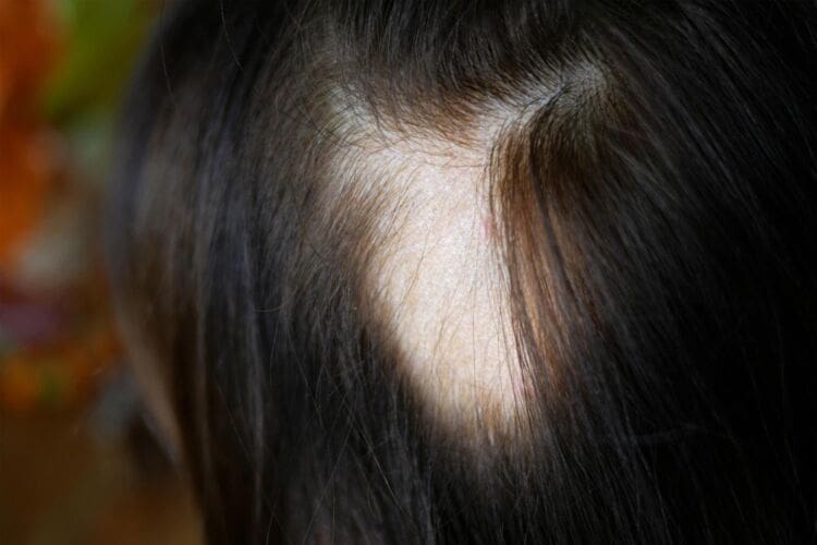 What is Alopecia?