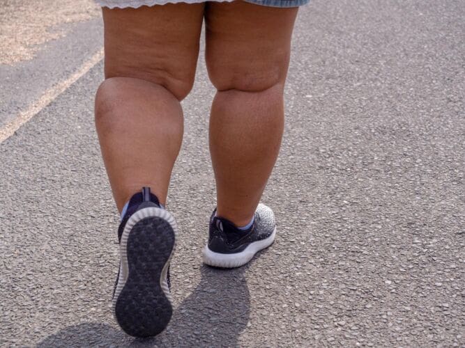 What is Lipoedema?