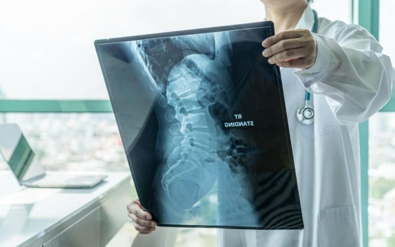 What is Spina Bifida