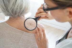 What is melanoma cancer