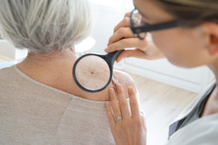 What is melanoma cancer