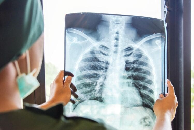 What is lung cancer