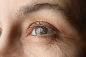 All about cataracts