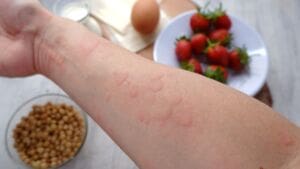 Understanding the Common Culprits - Top Allergenic Foods