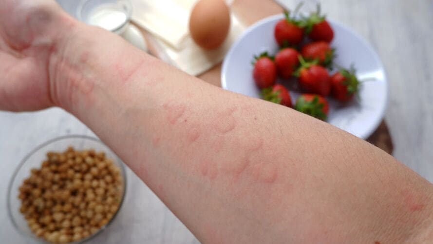 Anaphylaxis Unveiled Understanding the Severe Allergic Reaction
