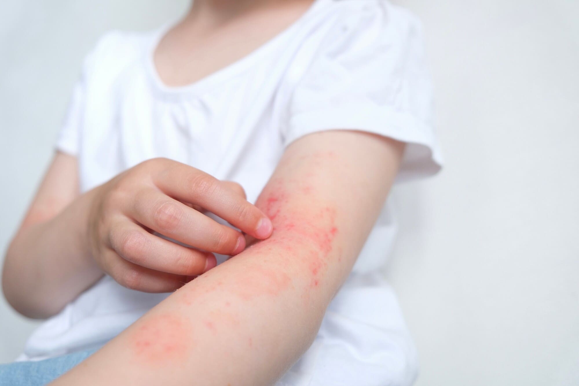 Child scratching arm, symptoms of eczema Child scratching arm, symptoms of eczema